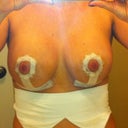 6 days post op