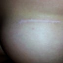 scar at almost 7 months