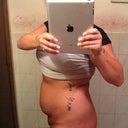 side view before surgery during weight loss.