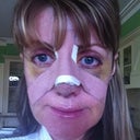 After - Day 6 (113 hours post op). Still swollen around jaw and bruised but continuing to improve.