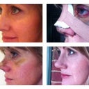Top: before & first week post surgery.  Bottom: After cast removal and approx. 4 weeks.