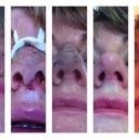 0 - 2 Months Nostril Shots - again so many changes & improvements :)