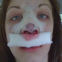 Right out of surgery
