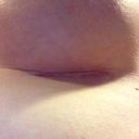Incision on left 3 weeks post op...looks lighter than in picture! Healed up and the scar is now thinning :))