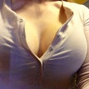 Busting out at 3weeks...swelling is all gone!!!! PS says these babies are staying this size...