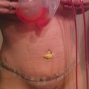 first look at new tummy! PO day 3.