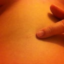 This is an old scar from my gallbladder removal. I spit stitches out of this one, it is the same color as my skin now, I'm pointing to it. I don't remember how long it took to lighten.