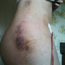 Bruising from lipo. 3 days po