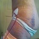 More lipo bruising and swelling.  3 days po