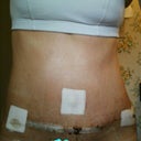 9 days po.  Notice more definition on side still with drain.