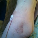 9 day po.  Bruising going away!  Liking the flat side view.  No more pot belly.