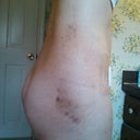 9 days po. Other side