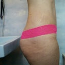 3wks po.  Bruises gone.  My waist so flat!  Makes my butt look huge (it's not)!