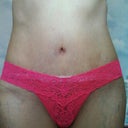 3 wks po.  One more wk and I can uncover the scar.