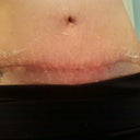 4 weeks po (flakes are dried up Mederma)