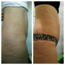 6wks po.  1st time no CG.  Before work and after work.  It's about as big as my original pot belly.