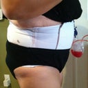 Post op day 2 even more swollen!
