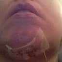 This is the under chin incision. It's larger than I thought and the stitches are very thick. There is a slight tightness under the chin but it is not painful.