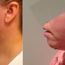 Before After profile one day post op. Dr. Leedy says this is the best indicator of what I will look like six months post op.