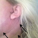 DAY THREE here you see one of my poor swollen ears. The black arrows point to all the swelling. It's very firm all along my jaw and under my chin.