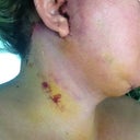 Here you see me in all my Bride of Frankenstein glory. Of the three procedures I have had before (breast implants, upper arm lipo, upper eyelids) this is the most difficult).