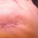 Stitches under my chin removed.