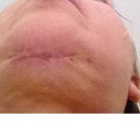 My chin incision AFTER two weeks