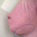 Here I've circled the hard, swollen lump under my chin. It is VERY noticeable from the sides.