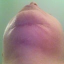 Chin scar post of six week