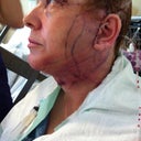 Neck area day after surgery