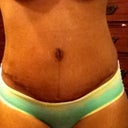 3 wks post op :)