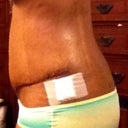 Left side with bandage from where the drain was.
