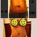 Side by side comparison. Pre-op vs 3 wks post op