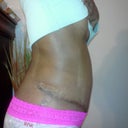 4wks post op. The flakes are from the mederma. See where the drain was?