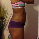 Right side 7wks post op