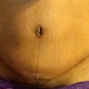 Scar and belly button up close. Took this pic last night when I was swollen.