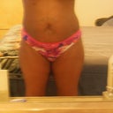 Before pic 1 week pre op
