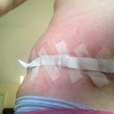 POD9, right hip, not too bad.