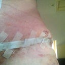 POD9, left hip, not too good, big bulge where bruise is above incision and dent below, revision possible I'm thinking.