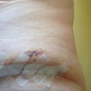 POD9, another view of left hip with bulge/bruise, doubt its swelling as too big!!