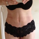 2 weeks post op
