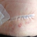 Left side to show how tiny my incision is under the thin micro pore. I got blisters from steri strips!!