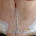My T junction as had a fleur de lis. 2 weeks PO.