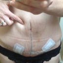My squashy upper ab area. 2 weeks PO