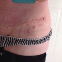 POD19 right hip
