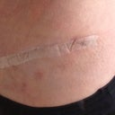 4 weeks PO, love how puckering going down so well