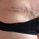 4 weeks PO left side, ledge/bulge side