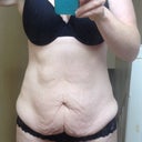 Pre op