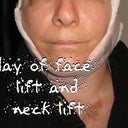 The day of my face lift and neck lift