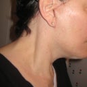 Week 5 close up of scar